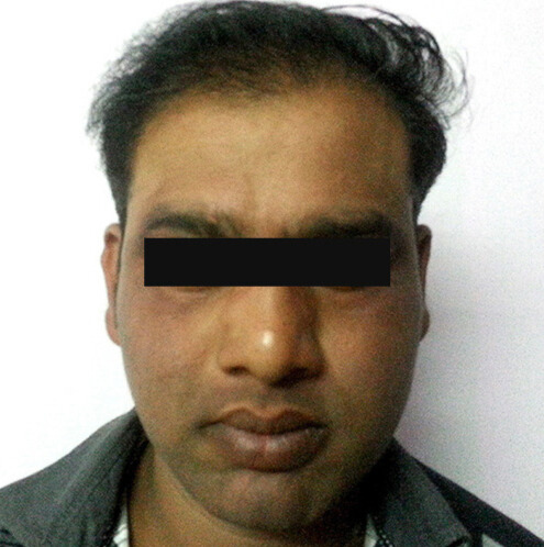 Arogyam Hair Transplant Grade 6 After