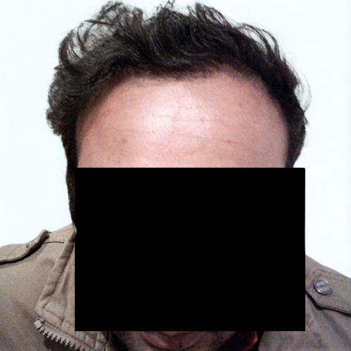 Arogyam Hair Transplant Grade 5 After