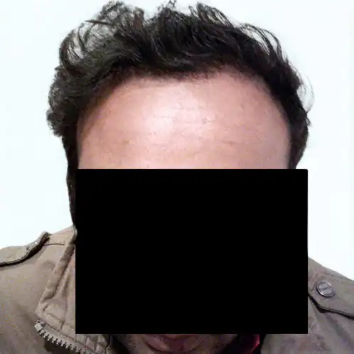 Arogyam Hair Transplant Grade 5 After