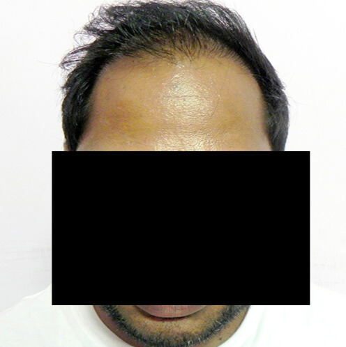 Arogyam Hair Transplant Grade 6 After