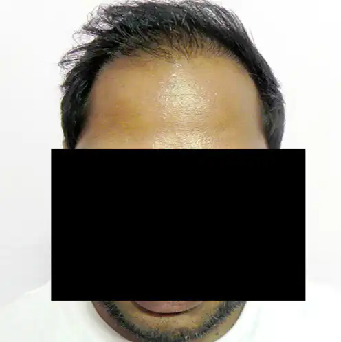 Arogyam Hair Transplant Grade 6 After