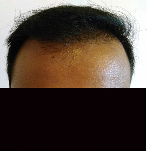 Arogyam Hair Transplant Grade 6 After