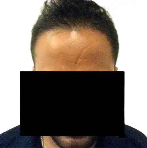 Arogyam Hair Transplant Grade 6 After