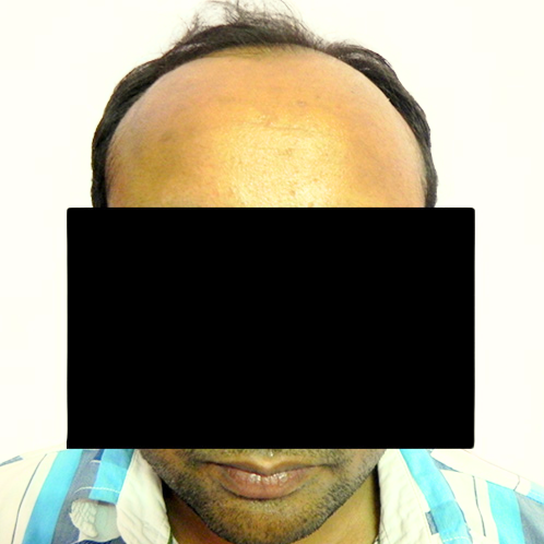 Arogyam Hair Transplant Grade 5 Before