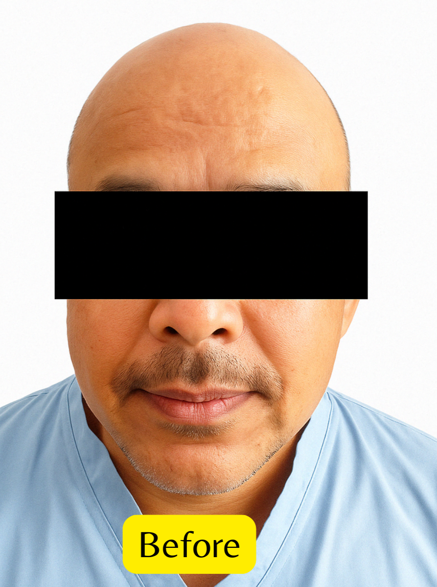 Arogyam Hair Transplant Grade 7 Before