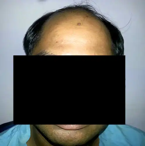 Arogyam Hair Transplant Grade 6 Before