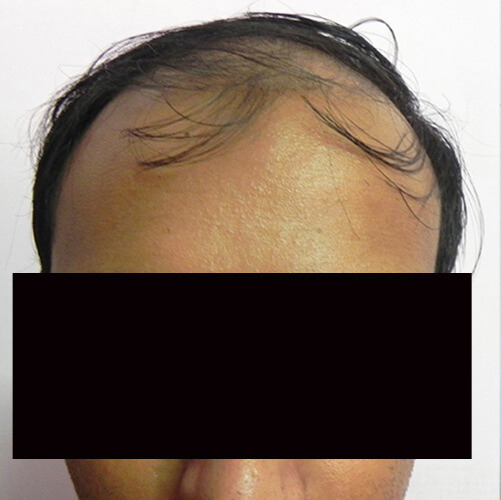 Arogyam Hair Transplant Grade 6 Before