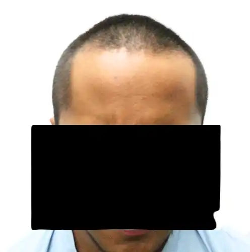 Arogyam Hair Transplant Grade 6 Before
