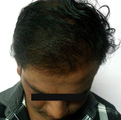 Arogyam Hair Transplant Grade 6 After