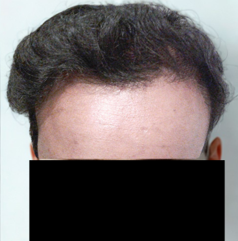 Arogyam Hair Transplant Grade 5 Before
