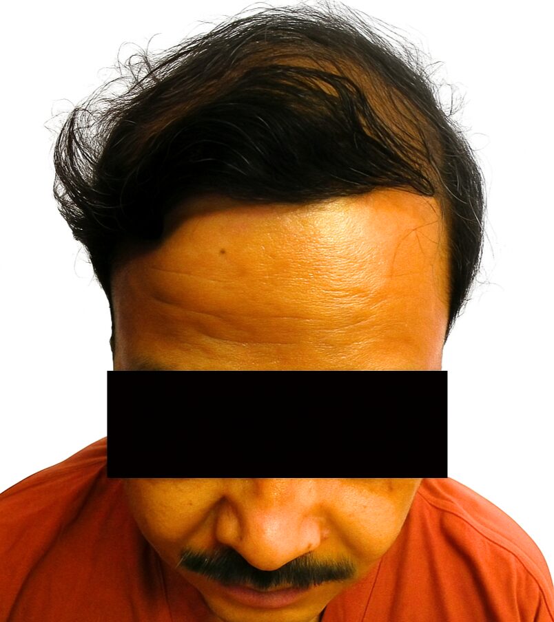 Arogyam Hair Transplant Grade 7 Baldness After