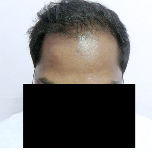 Arogyam Hair Transplant Grade 6 After