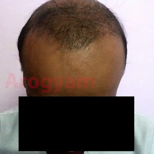Arogyam Hair Transplant Grade 7After