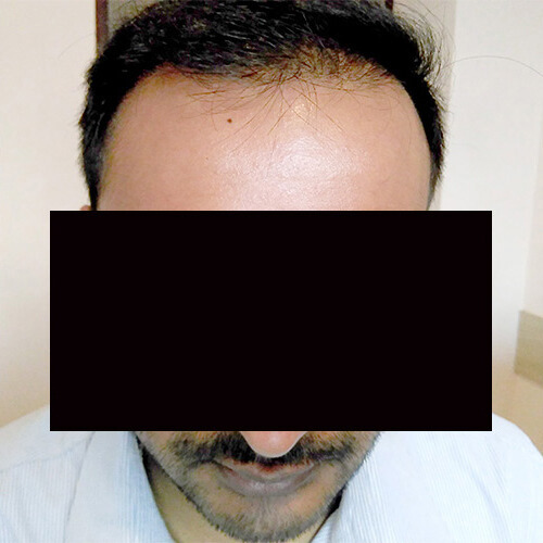 Arogyam Hair Transplant Grade 6 After
