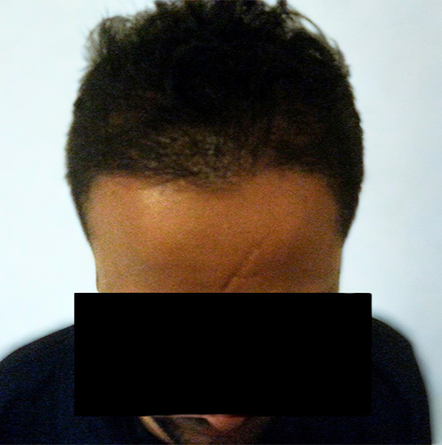 Arogyam Hair Transplant Grade 3 After