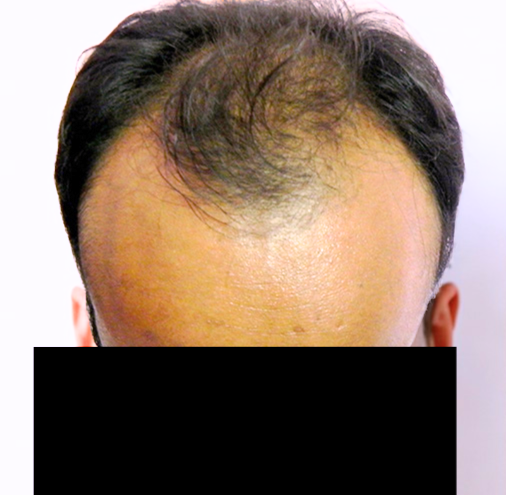 Arogyam Hair Transplant Grade 5 Before