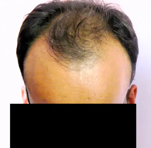 Arogyam Hair Transplant Grade 5 Before