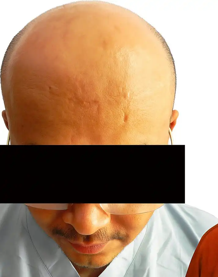 Arogyam Hair Transplant Grade 7 Baldness Before