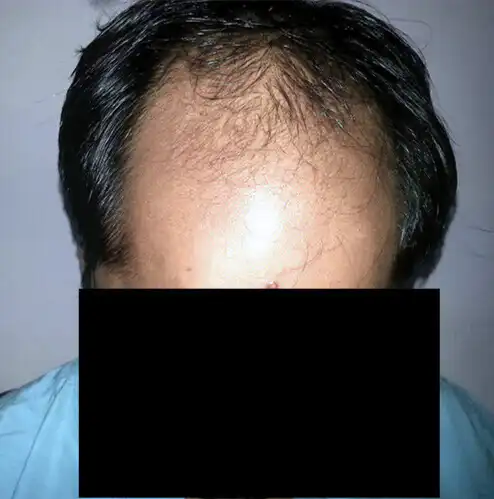 Arogyam Hair Transplant Grade 6 Before