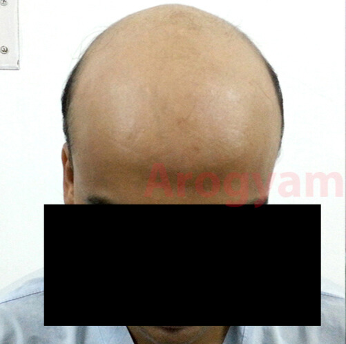 Arogyam Hair Transplant Grade 7 Before