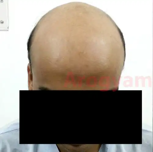 Arogyam Hair Transplant Grade 7 Before