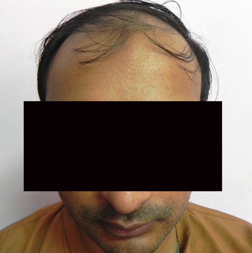 Arogyam Hair Transplant Grade 6 Before