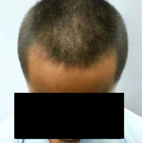 Arogyam Hair Transplant Grade 3 Before