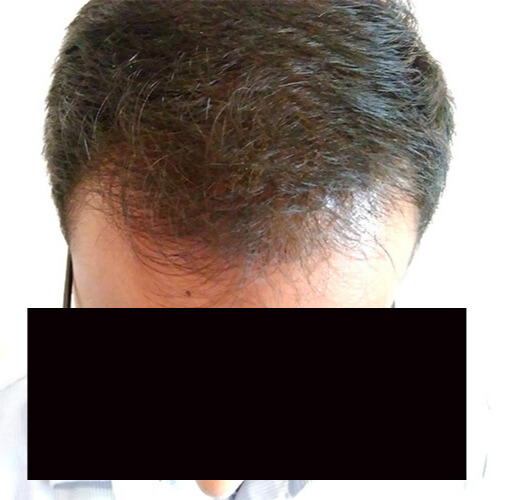 Arogyam Hair Transplant Grade 6 After