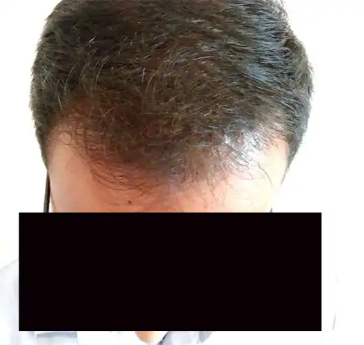 Arogyam Hair Transplant Grade 6 After