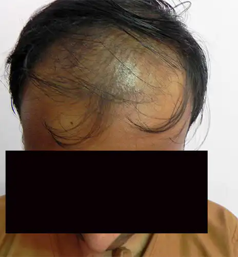 Arogyam Hair Transplant Grade 6 Before