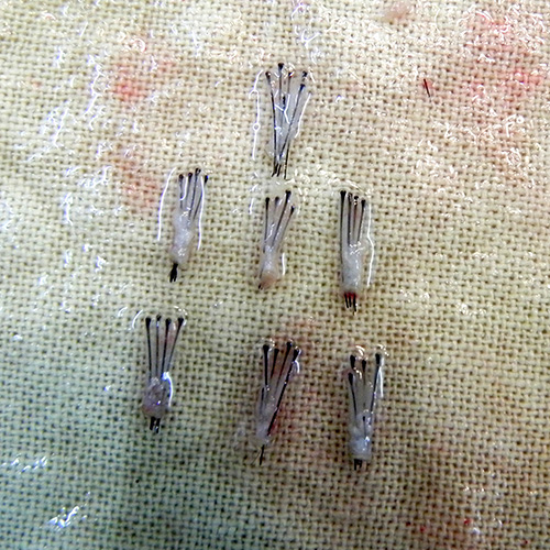 4, 5 and 6 follicle graft Arogyam