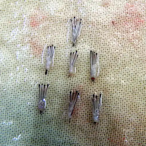 4, 5 and 6 follicle graft Arogyam