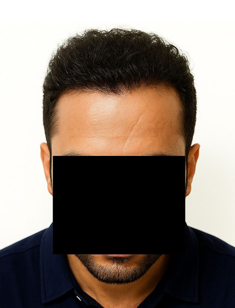 Arogyam Hair Transplant Grade 3 After