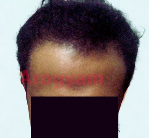 Arogyam Hair Transplant Grade 4 After