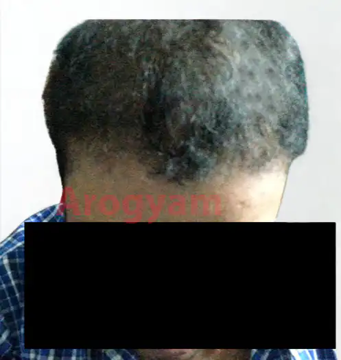 Arogyam Hair Transplant Grade 5 After