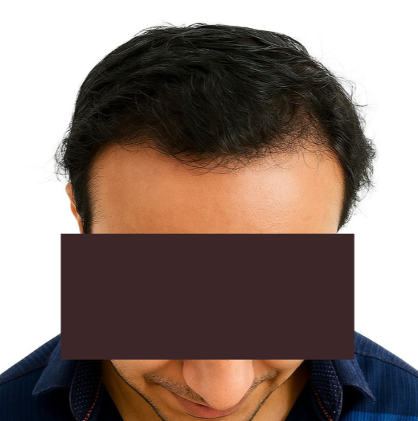 Arogyam Hair Transplant Grade 5 After