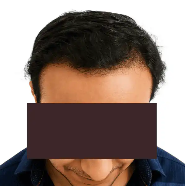 Arogyam Hair Transplant Grade 5 After
