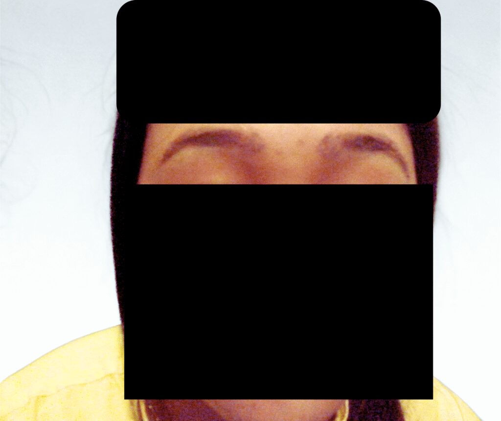 Arogyam Eyebrow Transplant After