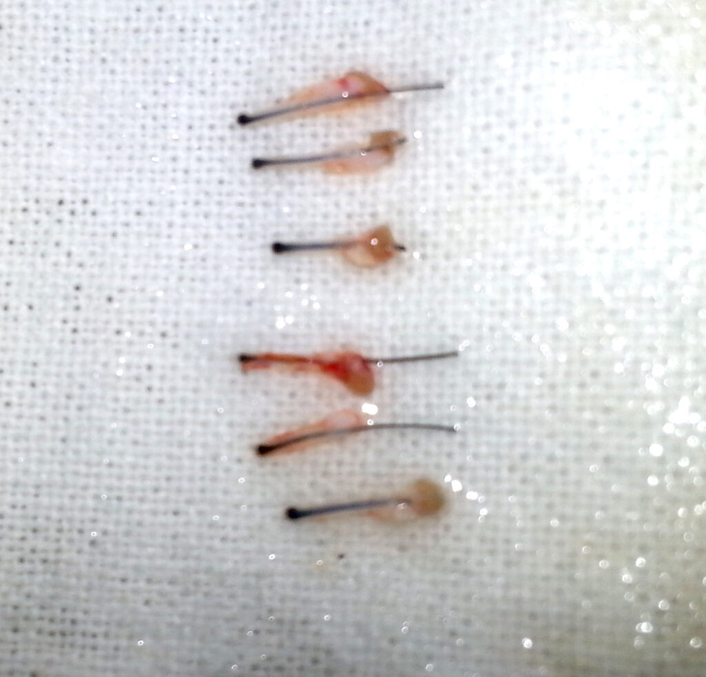 Arogyam Grafts from Beard