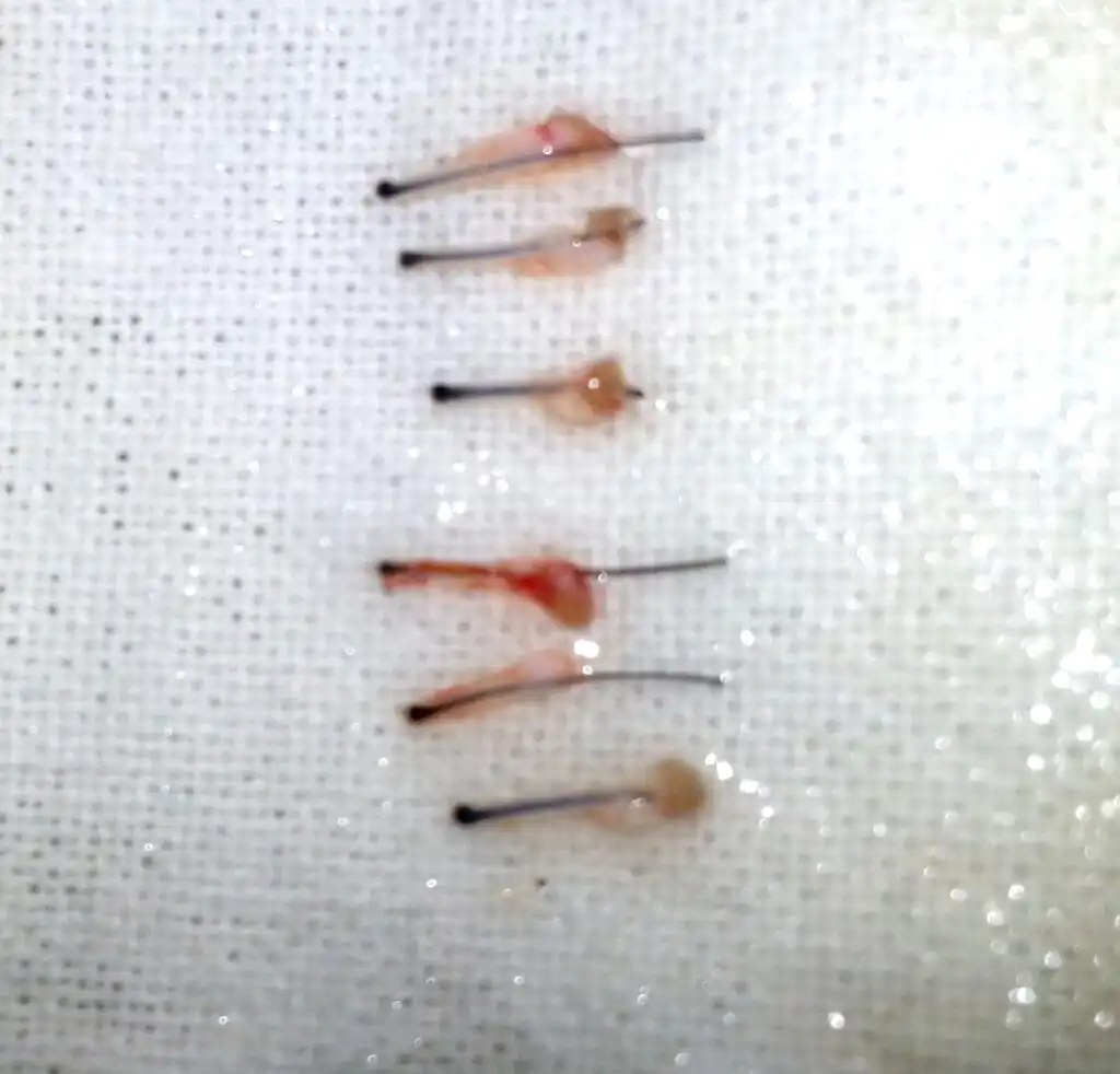 Arogyam Grafts from Beard