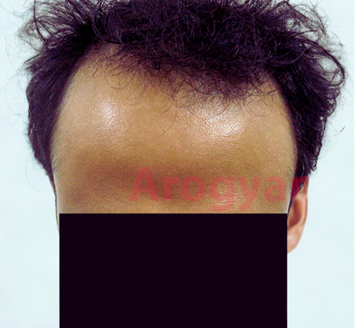 Arogyam Hair Transplant Grade 4 Before