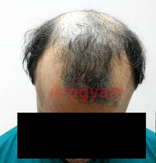 Arogyam Hair Transplant Grade 5 Before