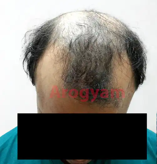 Arogyam Hair Transplant Grade 5 Before