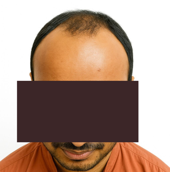 Arogyam Hair Transplant Grade 5 Before
