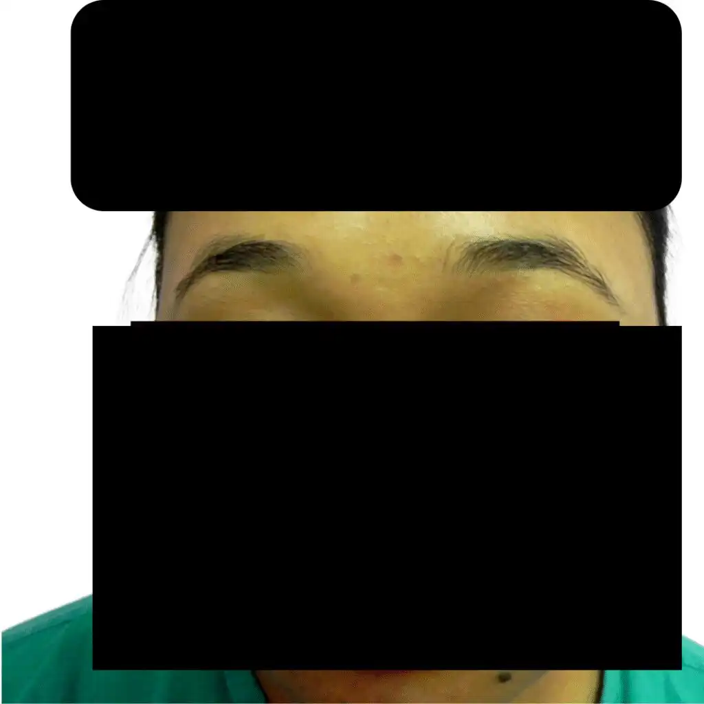 Arogyam Eyebrow Transplant Before