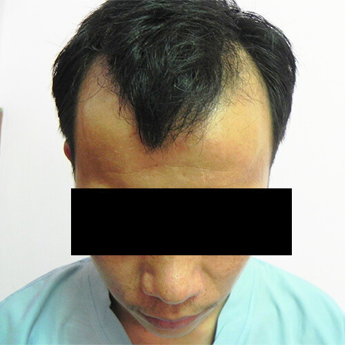 Arogyam Grade 3 Baldness Before