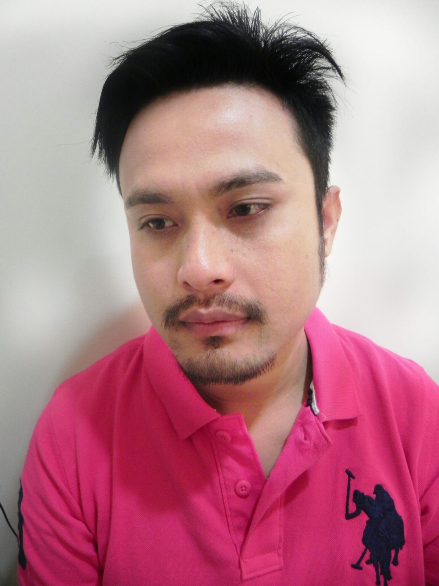 Arogyam Beard Transplant Before