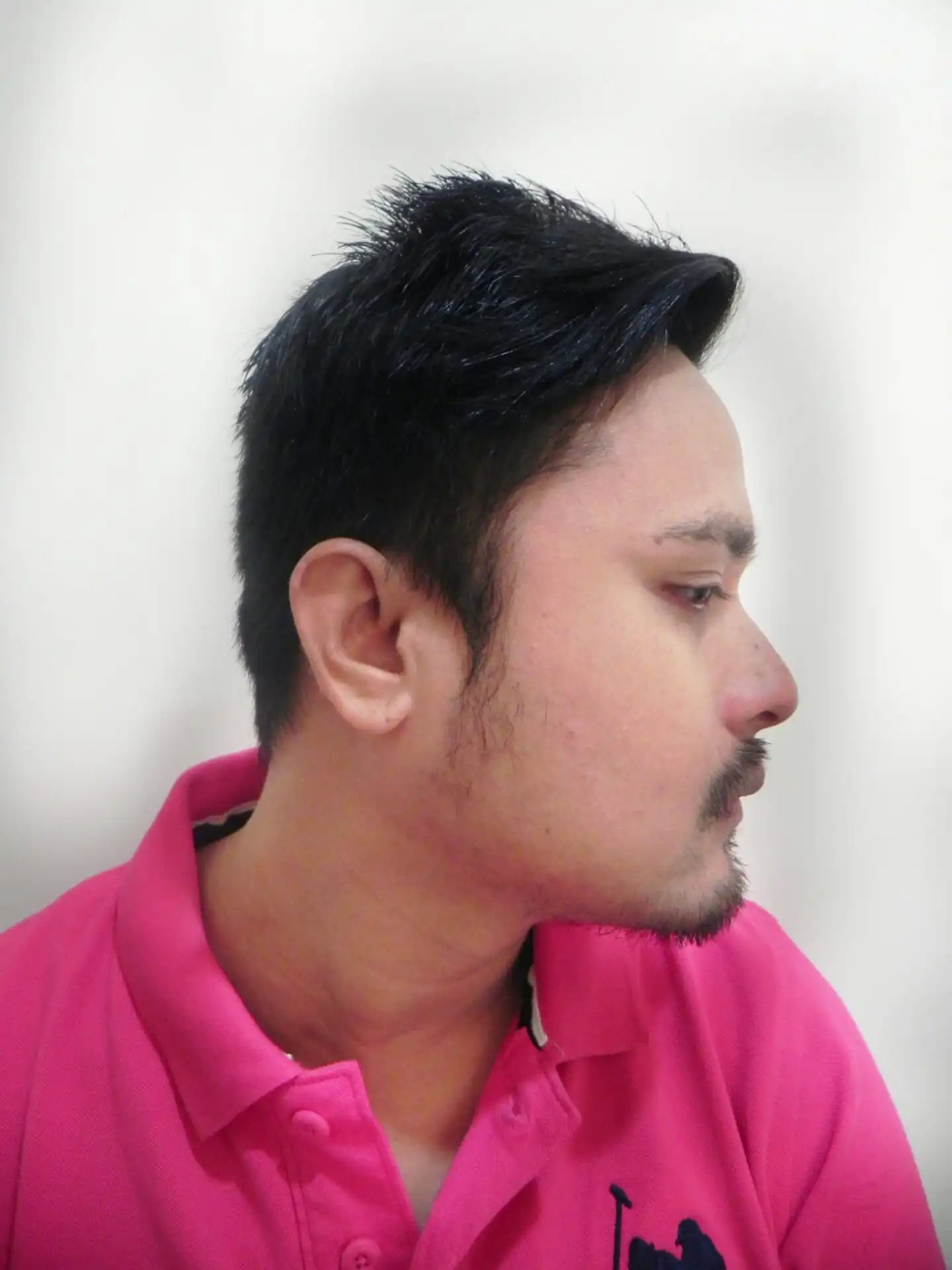 Arogyam Beard Transplant Before