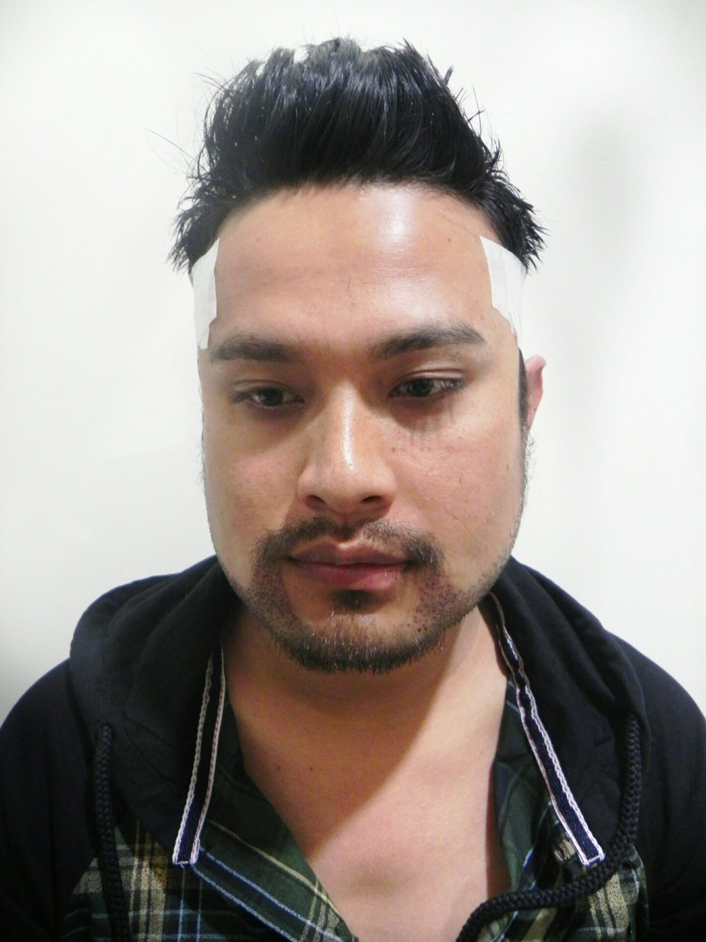Arogyam Beard Transplant After