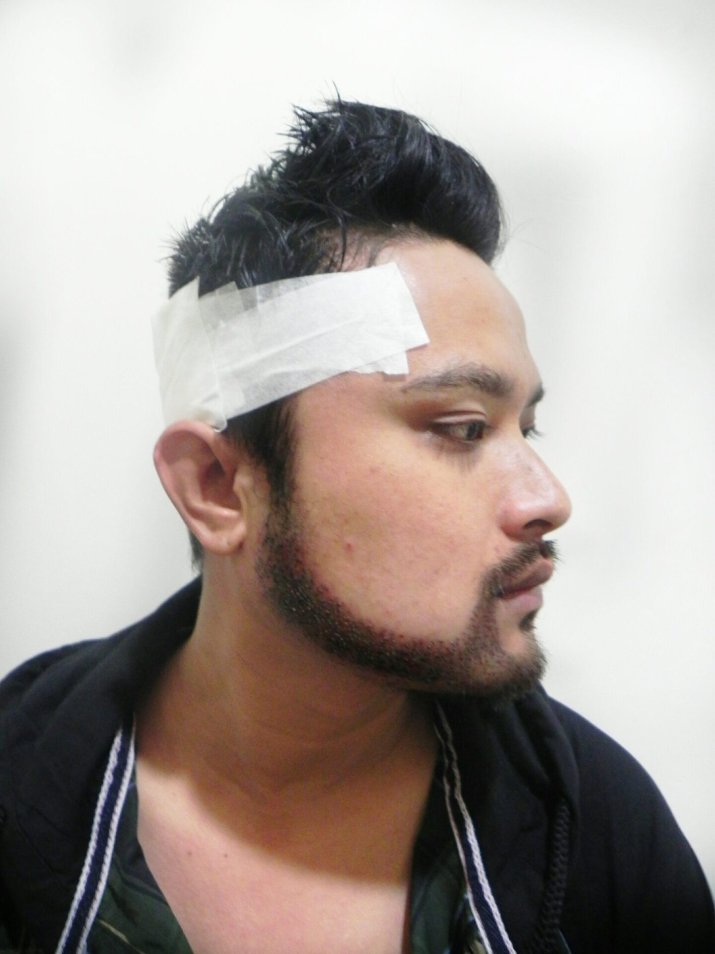 Arogyam Beard Transplant After